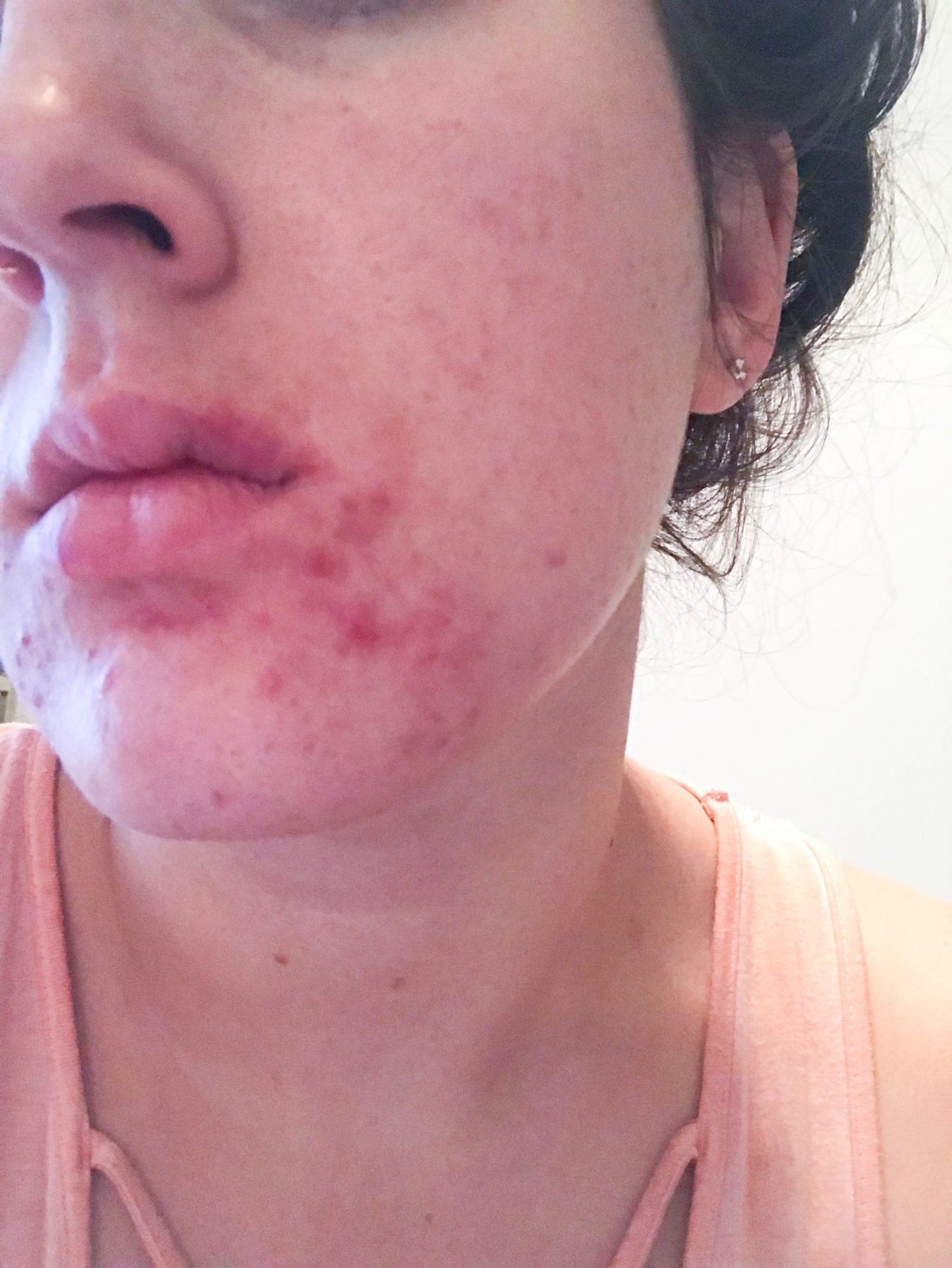 Accutane Results: Month 1 & 2 Update 